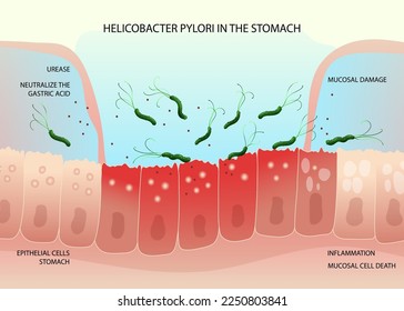 Helicobacter pylori bacteria on inflamed epithelial cells in human stomach. Vector illustration, cartoon style
