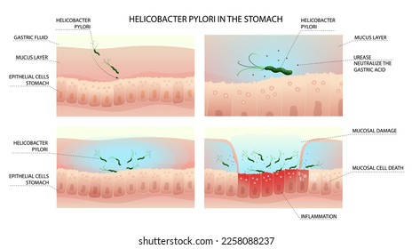 Helicobacter pylori infection process in human stomach with gastritis development infographic. Vector illustration, cartoon style
