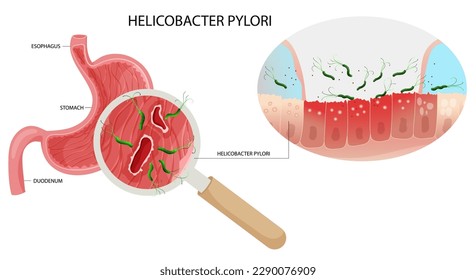 Helicobacter pylori infection in stomach ulcer under magnification. Vector illustration, cartoon style
