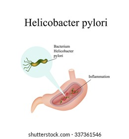 Helicobacter pylori in the stomach. Infographics. Vector illustration.