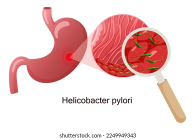 Helicobacter pylori in stomach mucosa under magnifying glass. Vector illustration, cartoon style, white background

