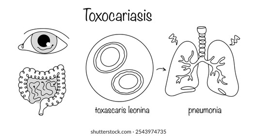 Helminthiasis, which manifests itself in humans in the ocular and intestinal forms. Hand-drawn manifestation of toxascarosis, causative agent and consequence. Black and white vector.