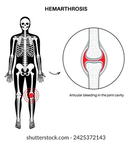 Hemarthrosis disease medical poster, bleeding inside of the synovial joints. A physical examination in an orthopedic clinic. Blood in joint cavity, hemophilia pain, swelling in leg vector illustration