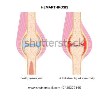 Hemarthrosis disease medical poster, bleeding inside of the synovial joints. A physical examination in an orthopedic clinic. Blood in joint cavity, hemophilia pain, swelling in leg vector illustration