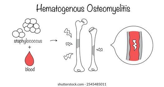 Osteomielitis Hematógena. Enfermedad infecciosa e inflamatoria del tejido óseo. Cuando el estafilococo penetra en los huesos tubulares, se desarrolla osteomielitis hematógena. Diagrama de enfermedades dibujado a mano.