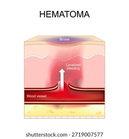 Hämatom. Blutergüsse und lokalisierte Blutungen. Blutgefäß nach Gefäßverletzung. Querschnitt der menschlichen Haut. Vektorgrafik