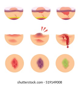 Hematomas Skin Stages Of Bruises Scenarios. Vector  Illustration