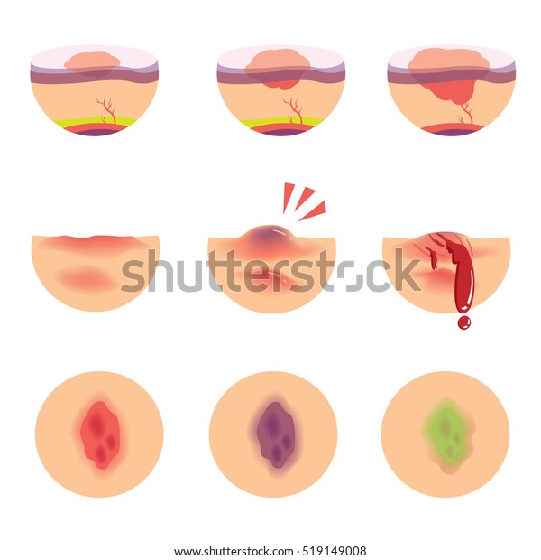 ヘマトマスの皮膚の傷の段階 ベクターイラスト のベクター画像素材 ロイヤリティフリー