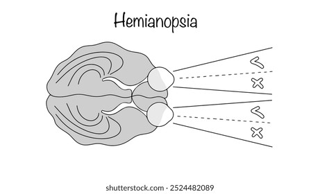 Hemianopsia. Cegueira bilateral em metade do campo visual. Uma condição em que o olho humano perde a capacidade de ver completamente o mundo ao seu redor. Cegueira parcial. Ilustração vetorial.