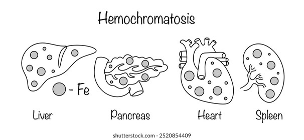 Hemochromatosis. An inherited condition in which the body absorbs and stores too much iron. The main human organs that accumulate excess iron in the body. Vector illustration for different uses.