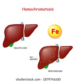 Hemochromatosis or Iron overload. Healthy liver and liver with  iron deposits. genetic disorder. comparison, and differences