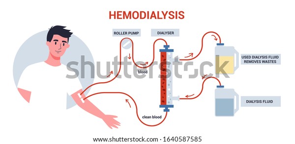 Hemodialysis Kidney Treatment Infographics Man Get Stock Vector ...