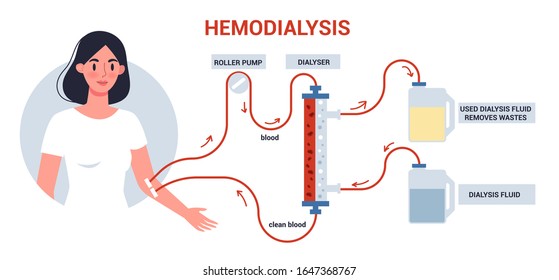 Hemodialysis for kidney treatment infographics. Woman get a kidney disease treatment. Patient having a internal injection. Vector illustration in cartoon style