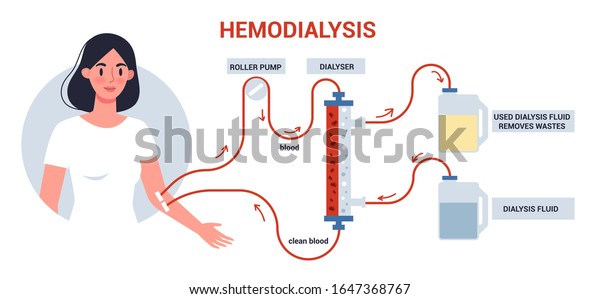 Hemodialysis for kidney treatment\
infographics. Woman get a kidney disease treatment. Patient having\
a internal injection. Vector illustration in cartoon\
style