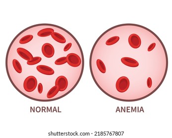 Hemoglobin. Anemia Symptoms, Blood Disease. Health Care Concept.