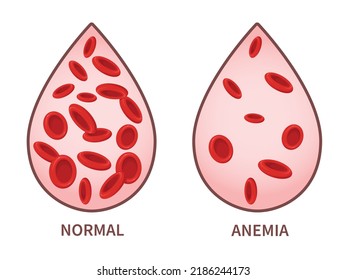 Hemoglobin. Anemia Symptoms, Blood Disease. Health Care Concept.