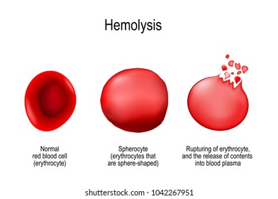 Hemolysis. Normal red blood cell, spherocyte, and rupturing of erythrocyte (release of contents into blood plasma). Vector illustration for medical use