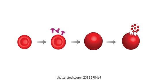 Hämolyse. Normaler roter Blutkörperchen, Sphärozyten, Zerstörung roter Blutkörperchen mit anschließender Freisetzung von Hämoglobin in das Blut. Vektorgrafik