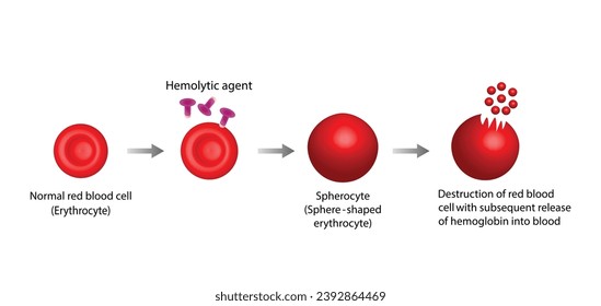 Hemólisis. Hemograma normal, glóbulos rojos, esferocitos, destrucción de glóbulos rojos con liberación posterior de hemoglobina en la sangre. Ilustración del vector