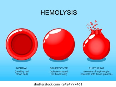 Hemolysis. Normal red blood cell, spherocyte, and rupturing of erythrocyte. Osmotic pressure. Vector poster. Isometric Flat illustration.