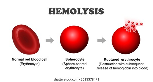 Hemolysis. Normal red blood cell, spherocyte and red blood cell destruction with subsequent release of hemoglobin into the blood. Vector education illustration