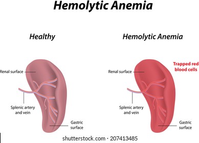 Hemolytic Anemia