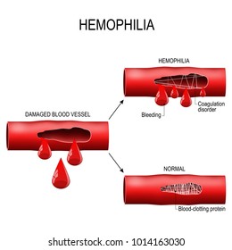 hemophilia. damaged blood vessel, Haemophilia (Coagulation disorder) and healthy blood vessel after bleeding.