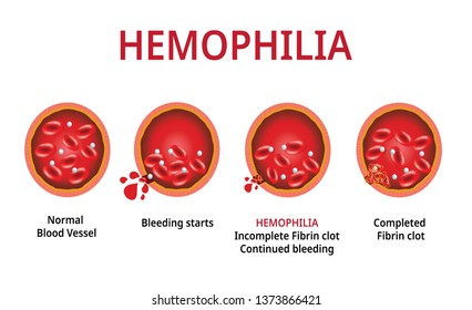 Hemophilia. damaged blood vessel, Haemophilia (Coagulation disorder) - Vector