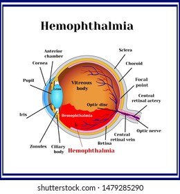 Hemophthalmia -  The Presence Of Blood In The Vitreous Body (sometimes Called Hemorrhage In The Eyeball).