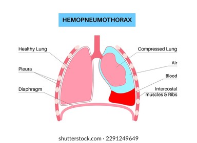 Lungenerkrankung des Hämoglobins. Kombination von zwei Erkrankungen Pneumothorax und Hämoothorax. Husten, Brustschmerzen, Atembeschwerden. Ungesunde innere Organe. Atemsystemgrafik