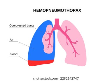 Enfermedad pulmonar por hemopneumotórax. Combinación de dos condiciones médicas: neumotórax y hemotórax. Tos, dolor torácico, dificultad para respirar. Órganos internos poco saludables. Ilustración del sistema respiratorio