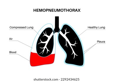 Hemopneumothorax lungs disease. Combination of two medical conditions pneumothorax and hemothorax. Cough, chest pain, difficulty breathing. Unhealthy internal organs. Respiratory system illustration