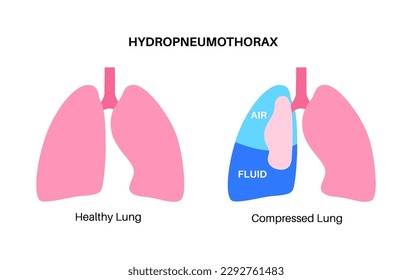 Hemopneumothorax lungs disease. Combination of two medical conditions pneumothorax and hemothorax. Cough, chest pain, difficulty breathing. Unhealthy internal organs. Respiratory system illustration