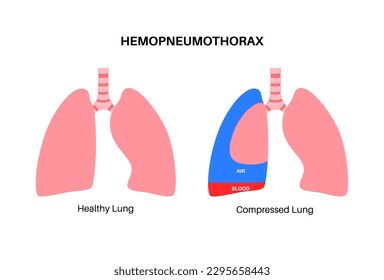 Enfermedad pulmonar por hemopneumotórax. Combinación de dos condiciones médicas: neumotórax y hemotórax. Tos, dolor torácico, dificultad para respirar. Órganos internos poco saludables. Ilustración del sistema respiratorio