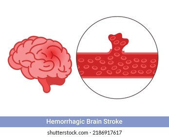 Hemorrhagic brain stroke concept. Apoplexy, cerebral hemorrhage, headache problem svg