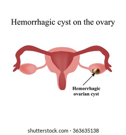 Hemorrhagic cyst on the ovary. Ovary. Infographics. Vector illustration on isolated background.