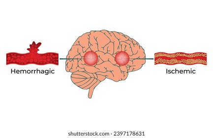 Hemorrhagic Ischemic Science Design Vector Illustration Diagram