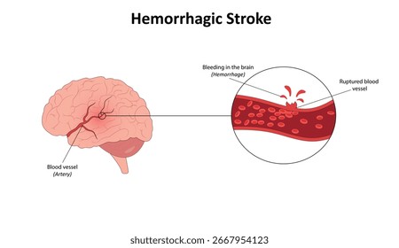 Accidente cerebrovascular hemorrágico en la Ilustración vectorial cerebral