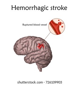 Hemorrhagic Stroke poster, banner. Vector medical illustration. white background, anatomy image of damaged human brain, ruptured blood vessel.