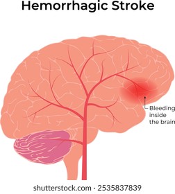 Diagrama de Ilustración vectorial de diseño de Ciencia de accidente cerebrovascular hemorrágico