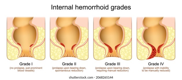 Hemorrhoid Grades. Stage Of Internal Piles, Degree Of Vascular Prolapse In The Anal Canal. Vector Illustration