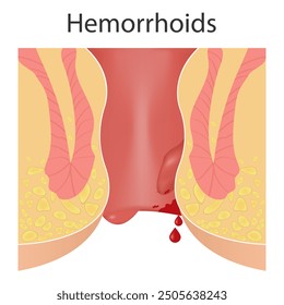 hemorrhoidal disease of the anus, inflammation causes bleeding through the patient's fistula.