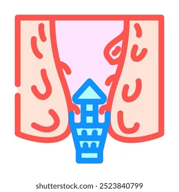 hemorroidectomia cirurgia cor ícone vetor. sinal de cirurgia hemorroidectomia. ilustração símbolo isolado