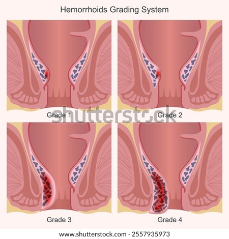 Hemorrhoids are categorized into 4 grades.Hemorrhoids are swollen veins in the lower rectum and anus.The veins around the anus stretch due to increased pressure in the lower rectum, hemorrhoids stage.