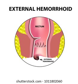 Hemorrhoids external. Rectum structure. Intestines. colon. Internal hemorrhoidal node. Infographics. Vector illustration on isolated background.