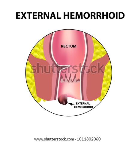 Hemorrhoids external. Rectum structure. Intestines. colon. Internal hemorrhoidal node. Infographics. Vector illustration on isolated background.
