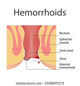 Hemorrhoids and inflammation cause bleeding through the patient's fistula. Cross-section of the rectum and anal canal