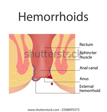 Hemorrhoids and inflammation cause bleeding through the patient's fistula. Cross-section of the rectum and anal canal