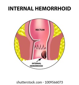Hemorrhoids internal. Rectum structure. Intestines. colon. Internal hemorrhoidal node. Infographics. Vector illustration on isolated background.