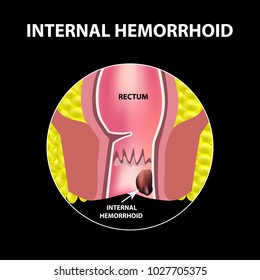 Hemorrhoids internal. Rectum structure. Intestines. colon. Internal hemorrhoidal node. Infographics. Vector illustration on black background